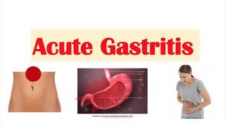 Acute Gastritis Stomach Inflammation  Causes Signs amp Symptoms Diagnosis Treatment [upl. by Cordey]