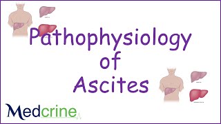 pathophysiology of ascites [upl. by Nareht]