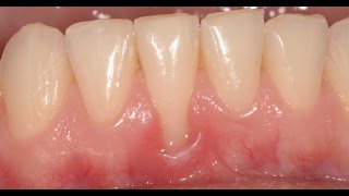 Connective Tissue Graft for Gum Recession [upl. by Marpet]