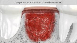 Geistlich Bio Oss [upl. by Aehtla]