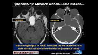 Sphenoid Sinus Mucous Retention Cyst vs Mucocele [upl. by Owen]