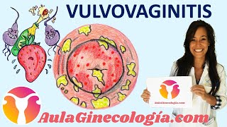 VULVOVAGINITIS Síntomas causas diagnóstico y tratamiento  Ginecología y Obstetricia [upl. by Ahserak314]