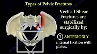 Pelvic Fracture Overview  Everything You Need To Know  Dr Nabil Ebraheim [upl. by Adalbert]