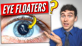 3 Must Know Facts About EYE Floaters [upl. by Siloum]