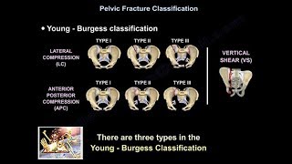 Pelvic Fractures  Everything You Need To Know  Dr Nabil Ebraheim [upl. by Norri175]