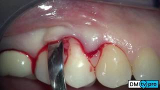 Single gingival recession treatment with Mucograft matrix [upl. by Sexela]