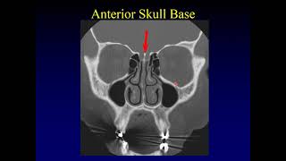 Imaging of the Paranasal Sinuses 1 [upl. by Martineau]