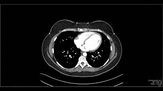 Abdominal Anatomy on Computed Tomography [upl. by Otrevogir]