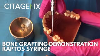 Basic Bone Grafting Procedure Demonstration With Raptos Syringe Citagenix Products  Citagenix [upl. by Latta]