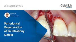 Periodontal Regeneration of an Intrabony Defect  Courtesy of Dr Pierpaolo Cortellini [upl. by Nealon]