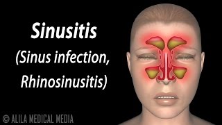 Sinusitis Animation [upl. by Pillow439]